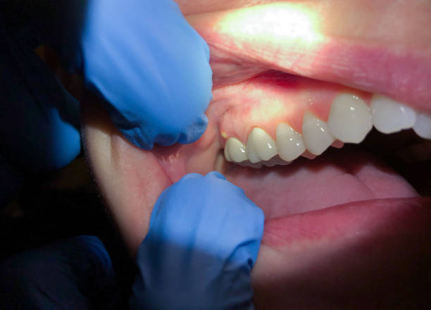 Best Emergency Broken Tooth Repair in Clifton Knolls Mill Creek, NY
